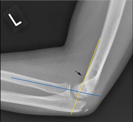 dependent on type Supracondylar Fracture Keys to radiographic diagnosis----abc S Adequate views (True lateral, AP)