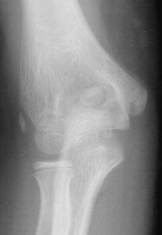 13 Elbow ossification