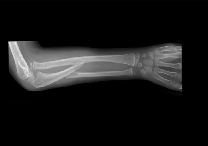 14 Monteggia fracture Proximal ulnar fracture with radial head dislocation Ulna rarely fractures alone