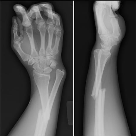 Orthopedic consult in ED Galeazzi fracture Distal radius shaft fracture with dislocation of the distal