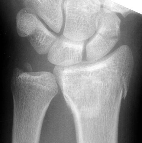 15 Boxer s Fracture Distal 5th metacarpal fracture Most common
