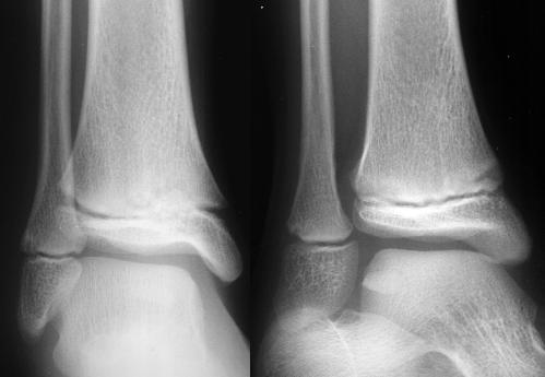 plate Physeal fractures occur in children where sprains commonly occur in adults Physeal
