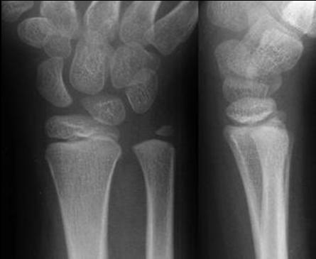 Salter-Harris Type I Fracture through the physis (5%) Separation of the epiphysis from the