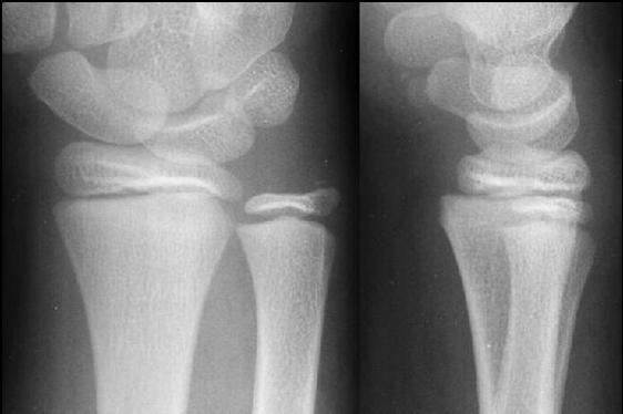 6 Salter-Harris Type I Point tenderness over area of growth plate with a normal radiograph = SH I fracture