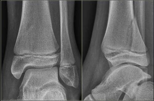 physeal fracture (75%) Fracture through the metaphysis and physis Fracture produced Entire epiphysis with