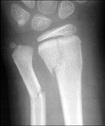 7 Salter-Harris Type III (E) Fracture through epiphysis and physis