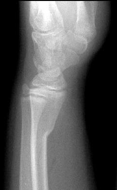 Fractures Occur in the metaphysis from a compressive load