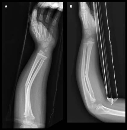 Reduction depends on age and degree of angulation Avulsion Fractures Apophysis-bone
