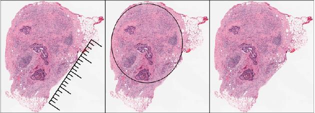 Distant extension : tumour deposits TNM 5 th edition TNM 6 th edition TNM 7, 8 th edition >3 mm