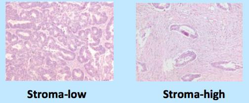 Ratio tumeur/stroma Pronostic défavorable Mesker WE et al. Cell Oncol Cell Oncol.