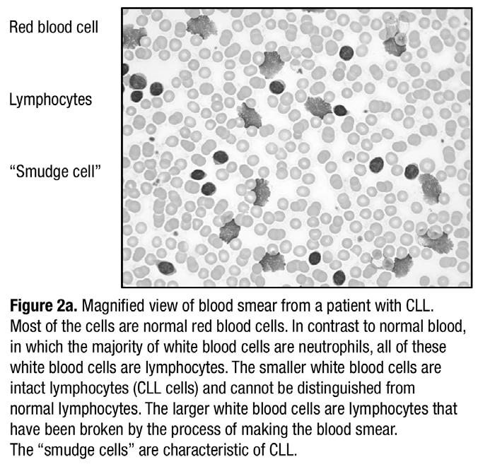 Page 3 of 10 CLL/SLL is caused when the B lymphocytes that come from a single, abnormal cell accumulate.