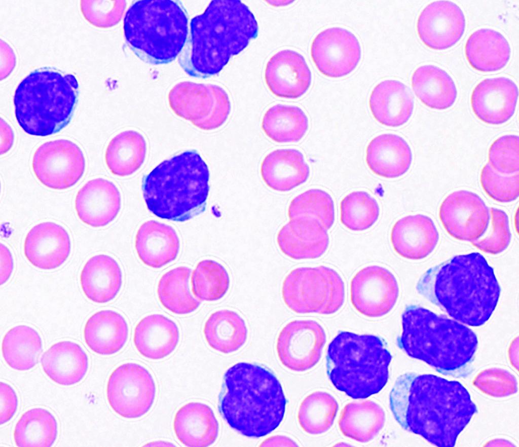 Hematopathology / ORIGINAL ARTICLE FISH Results Cases With CCND1/IGH Fusion Classified as Mantle Cell Lymphoma Two cases initially regarded as CLL based on clinical manifestations demonstrated
