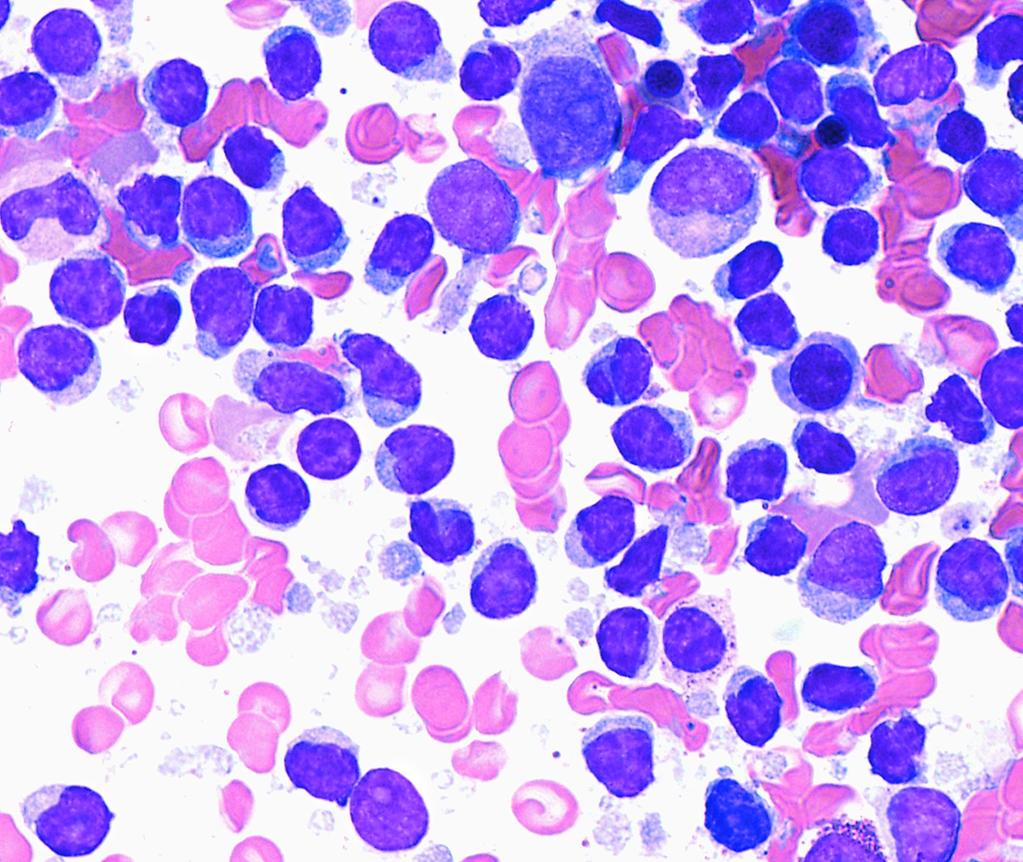 Hematopathology / ORIGINAL ARTICLE A B Image 2 A, Chronic lymphocytic leukemia (CLL) with bcl-11a translocation involving the bone marrow aspirate.