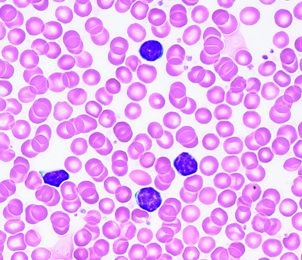 Hematopathology / ORIGINAL ARTICLE MCV, 92 µm 3 [92 fl]; platelet count, 300 10 3 /µl [300 10 9 /L]; lymphocytes, 84% [0.84]; neutrophils, 15% [0.15]; and monocytes, 1% [0.