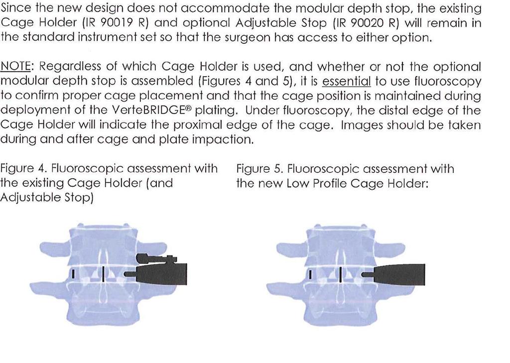 Cage Insertion The Cage Holder (IR 90019 R) and optional Adjustable Stop (IR 90020 R) are available in the standard instrument set so that the surgeon has access to either option.