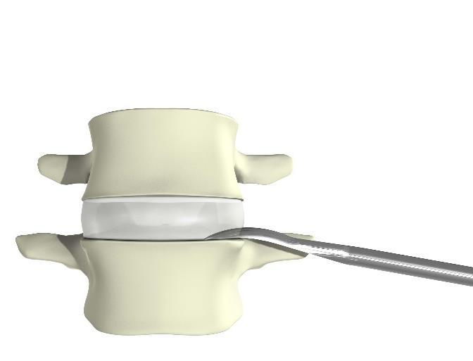 Discectomy & Endplate Preparation Once the desired disc space is reached, a Penfield is used to sweep the residual muscle off of the disc space.