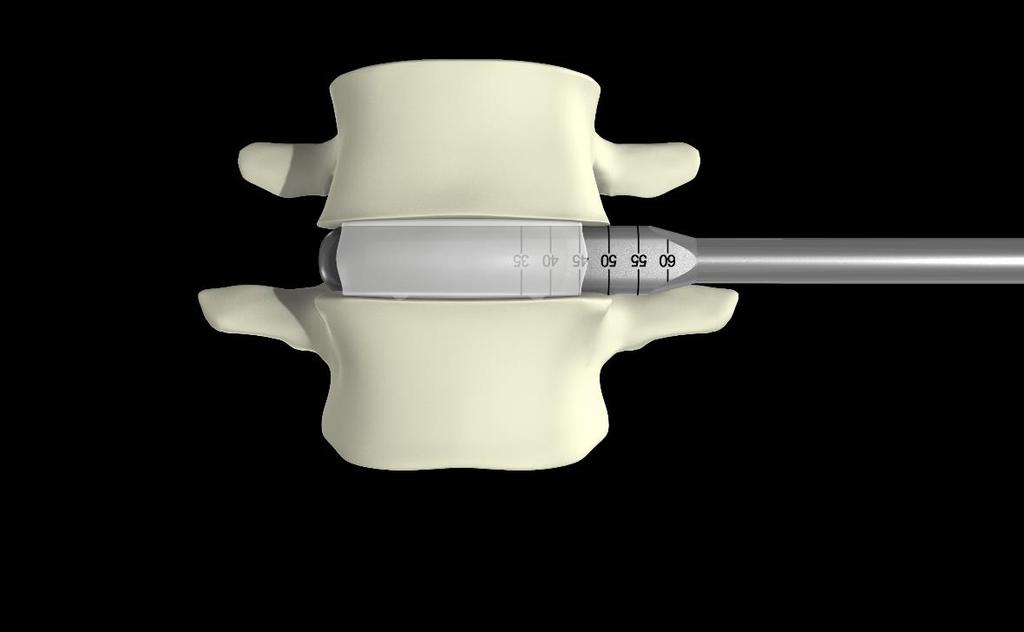 Discectomy & Endplate Preparation Fully insert the Paddle
