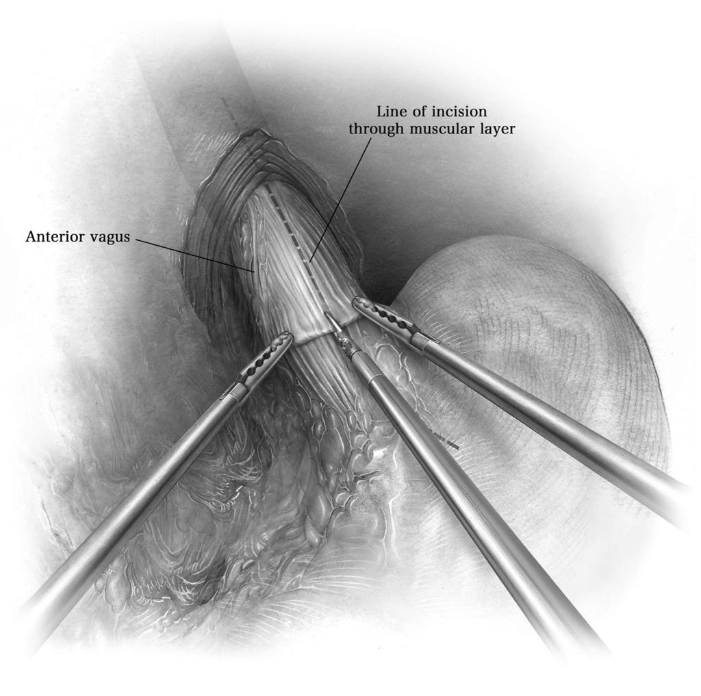 Laparoscopic heller myotomy for achalasia 11 Figure 9 The easiest place to start the myotomy is on the distal esophagus.