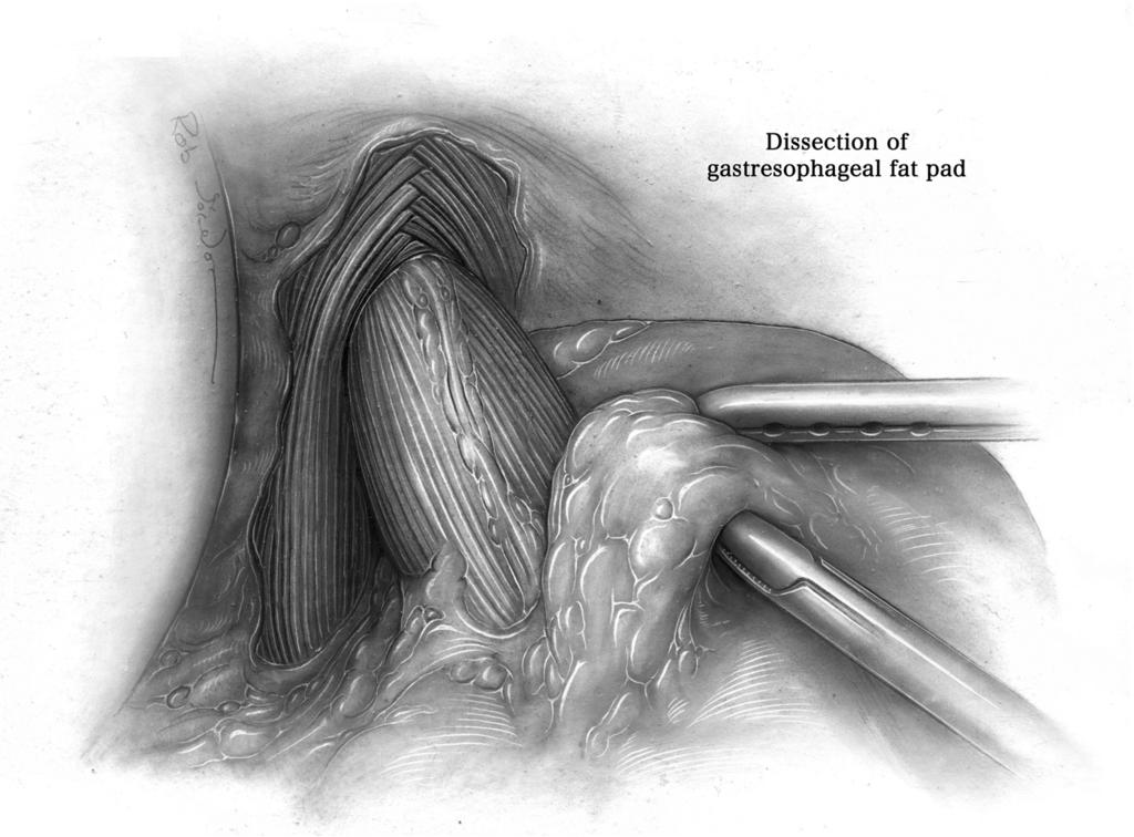 8 A. Pierre Figure 6 As the fat pad is removed, the anterior vagus nerve will come into view.