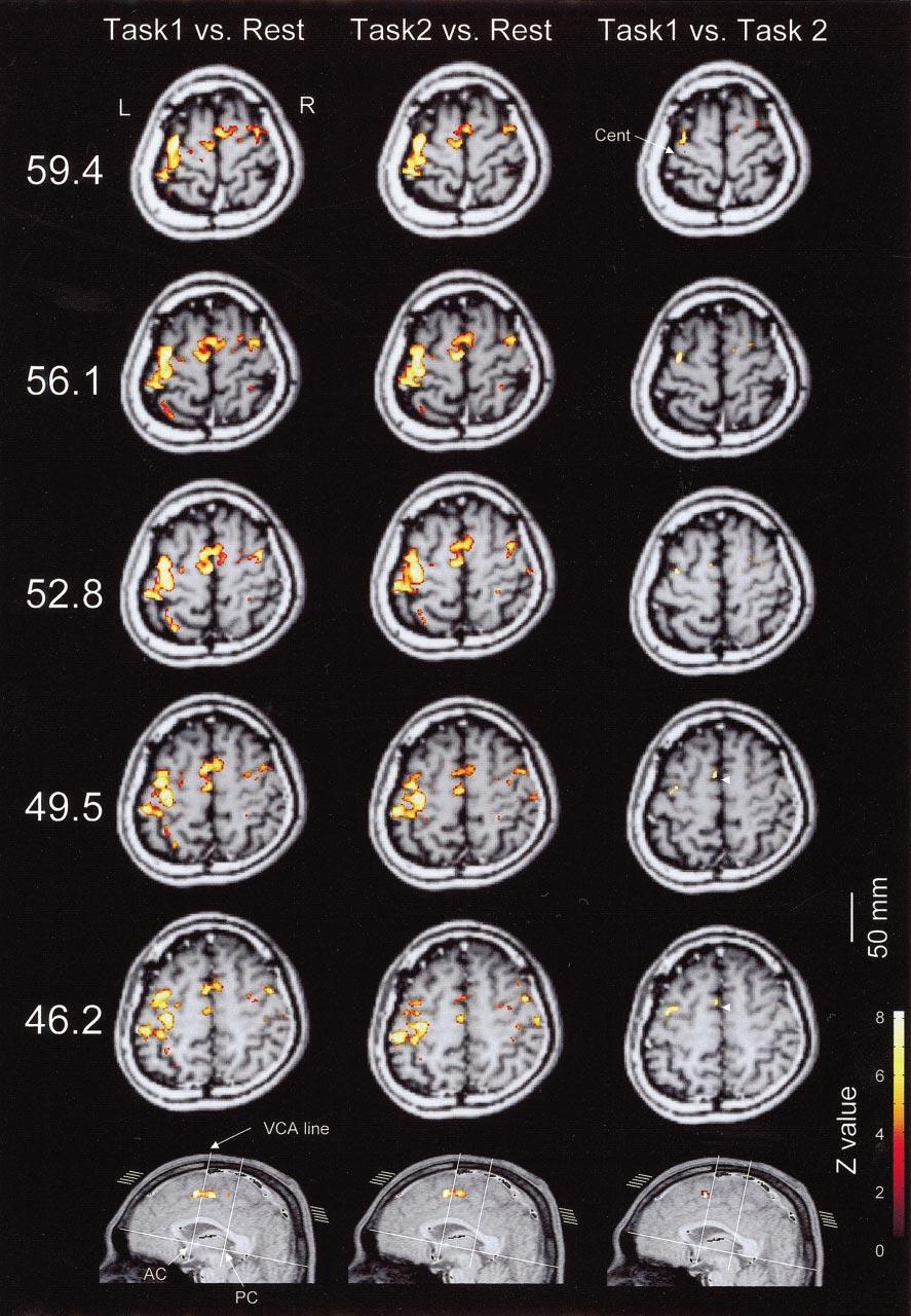 CORTICAL ACTIVATION DURING A CONDITIONAL MOTOR TASK 1669 FIG. 1. Activation maps from a representative subject performing the tasks.