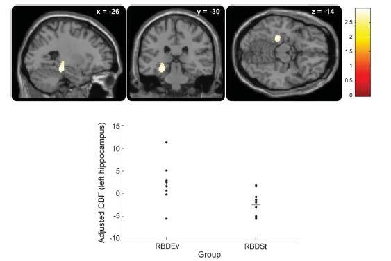 Hippocampal perfusion in Idiopathic RBD: with