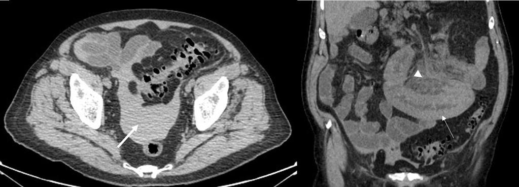 Findings in spontneous intrmurl intestinl hemtom imging Fig 3. Mle ptient, ge 82 yers, with spontneous intrmurl intestinl hemtom secondry to nticogultion tretment.