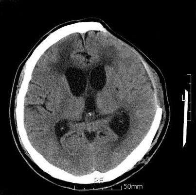 Type III was consisted with a tense convex cranial defect with the brain parenchymal herniation. In this study, type III was excluded because the shunt operation was first option in little doubt.