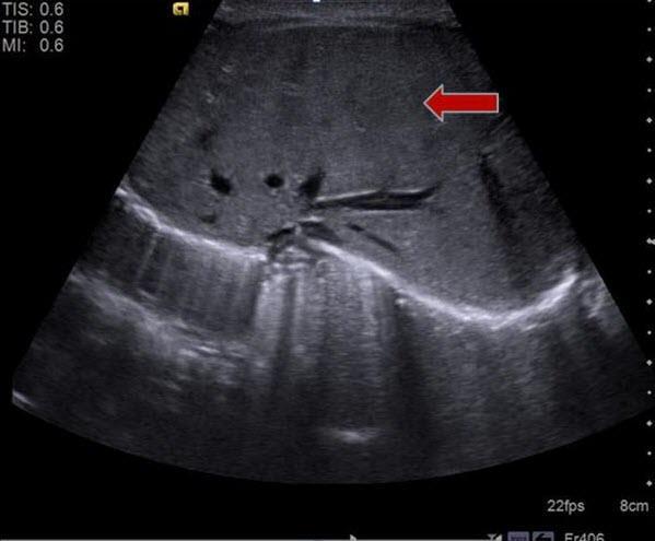 Figure 6: Newborn female with situs ambiguous, levocardia, nonrotation.