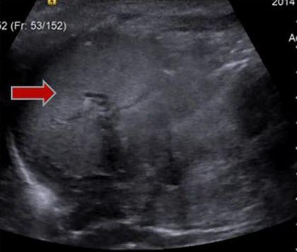left upper quadrant. Figure 8: Newborn female with situs ambiguous, levocardia, nonrotation.