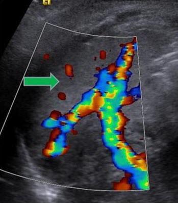 (block green arrow) in the right upper quadrant. Vascular flow is demonstrated in the hilum.