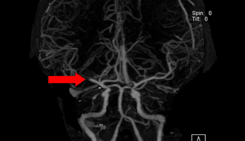 and easy to interpret CT Angiogram CT Perfusion MRI Dynamic scanning during the arterial phase