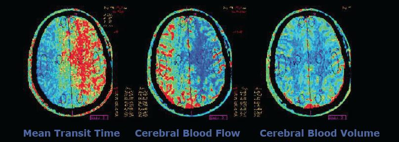 9/18/16 Technician dependent for reliability Routine maps: Mean Transit Time (MTT) Cerebral Blood Flow (CBF) Cerebral Blood Volume (CBV) Increased MTT, decreased