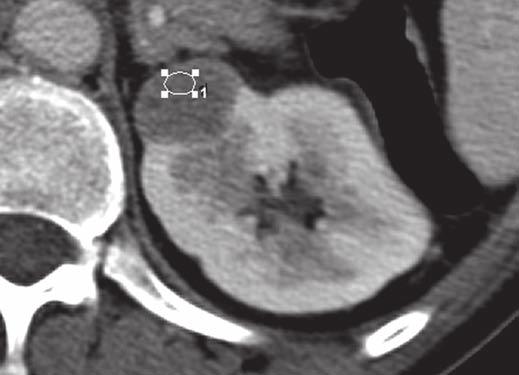 A special attempt was made to perform at least 1 year of cross-sectional imaging follow-up for patients with benign masses who did not undergo surgery.