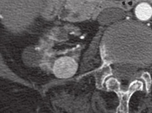 CT of Small Solid Renal Lesions C D Fig. 3 (continued) Ball pattern in two masses that deform renal contour and have sharp distinct interface between mass and surrounding renal parenchyma.