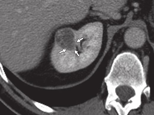 CT of Small Solid Renal Lesions Fig. 6 48-year-old woman with renal cell carcinoma. CT scan shows angular interface with renal parenchyma (arrows).