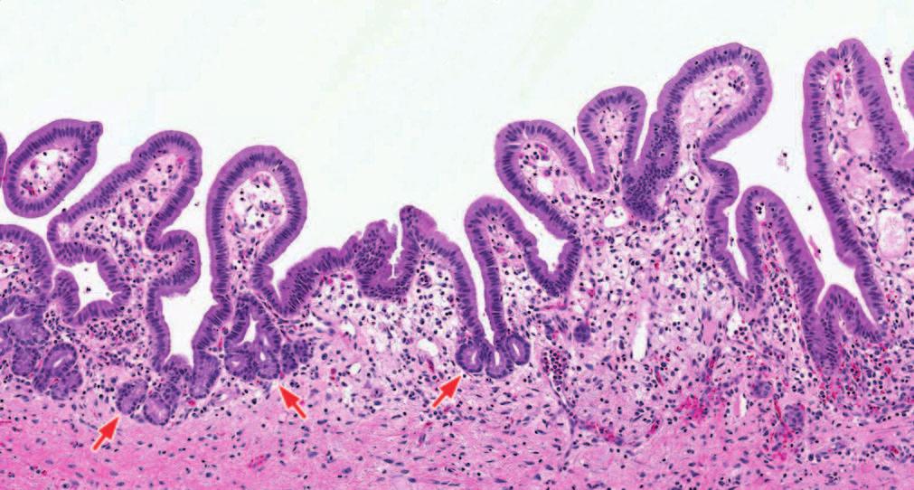 Figure 1. Biliary mucosa is lined by cuboidal cells with basally located nuclei and lightly eosinophilic cytoplasm, without goblet cells.