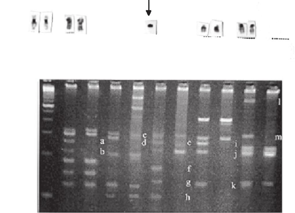 557 Cytogenetic and Y microdeletion studies of infertile men A minimum of 100 metaphases were analyzed per patient, with the aim of detecting chromosomal mosaicism equal to or greater than 3% with a