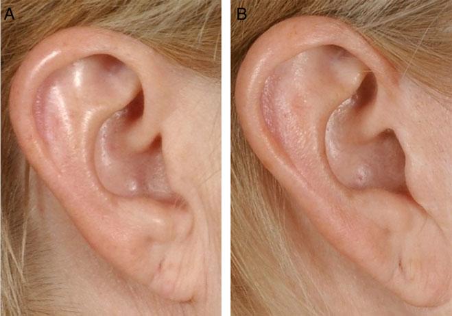 874 Aesthetic Surgery Journal 36(8) and even rejuvenation to the earlobe. The opening in the earlobe is repaired using a single 6-0 Monocryl suture to avoid dislodgement of the fat graft.