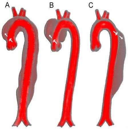 Aortic dissection Ascending aortic dissection : High risk of sudden death