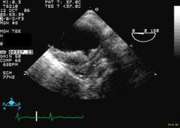 vessel rupture Most common in descending aorta Risk factors