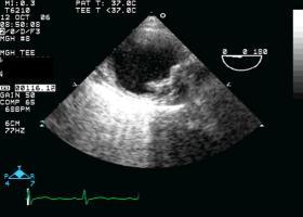 Penetrating aortic ulcers with superimposed