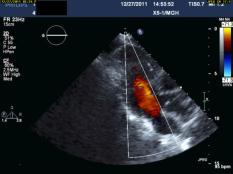 due to atherosclerotic ulcer 57 yo F
