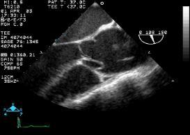 Type I aortic dissection 10 days