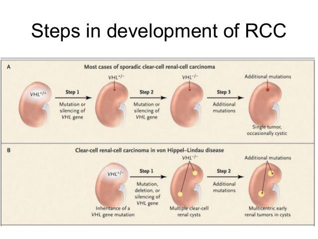 Genetic mutations lead to kidney cancer (Renal cell carcinoma) An