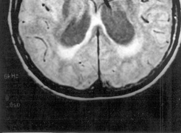 dilatation with marked peri-ventricular
