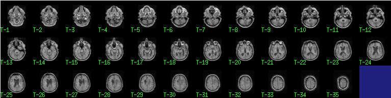 MRI Co-registered PET CBF maps ROIs: Cerebrum ROIs: Cerebellum Figure 4.