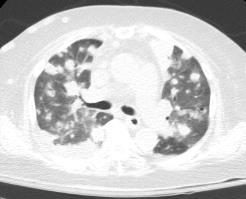 PCP in HIV-negative Patients Case #2 Clinical HIV-positive Subacute presentation (weeks) Survival >80% Radiology Diffuse bilateral