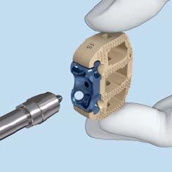 Insert Implant OPTION B: Using Implant Holder Instruments 03.802.039 Implant Holder, for SYNFIX LR Implant E5211-3 Wrench, 10mm Optional instrument 397.