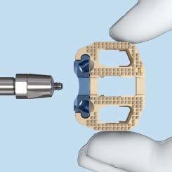 The implant holder must be attached firmly to the implant during the entire implant insertion procedure to avoid damage to the implant holder or the plate.