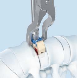 A distractor can be used to assist with guiding the implant into the disc space.